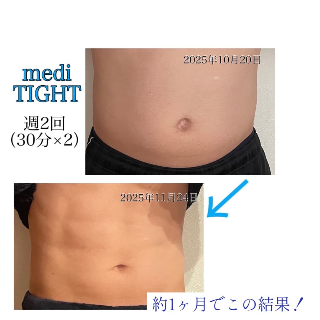 お腹痩せのBeforeとAfter(medi TIGHT・週2回)