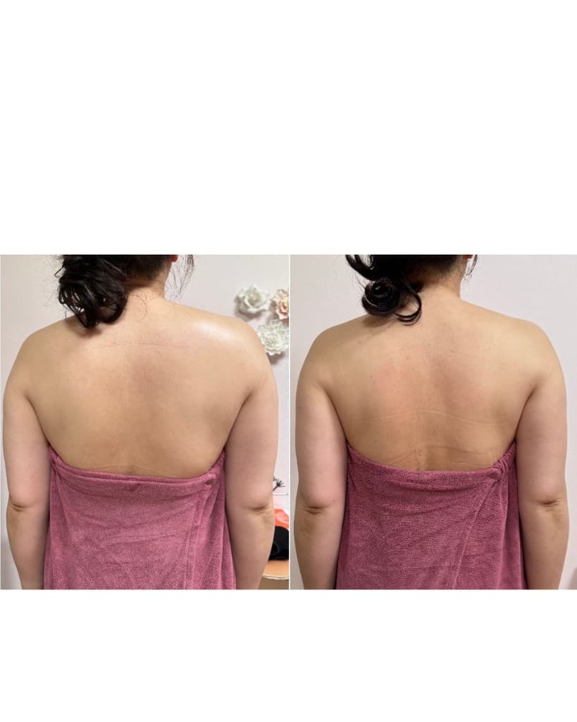 上半身コースのBeforeとAfter(背面・肩・背中)