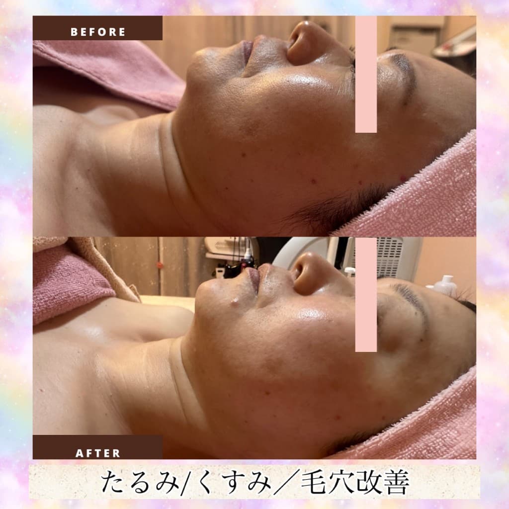 小顔形成リンパマッサージのBeforeとAfter(横顔・たるみ・くすみ・毛穴)