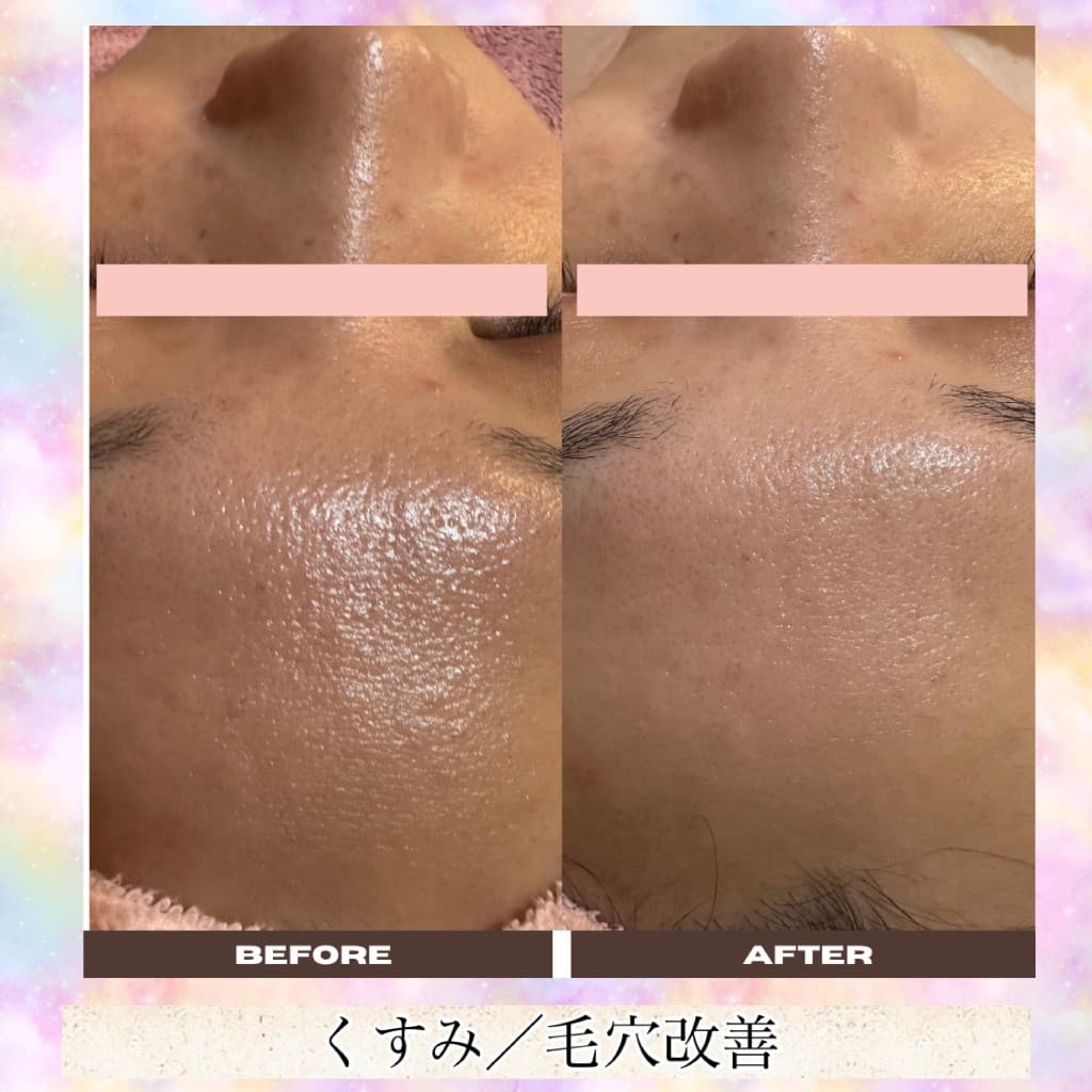 毛穴洗浄のBeforeとAfter(額・くすみ・毛穴)