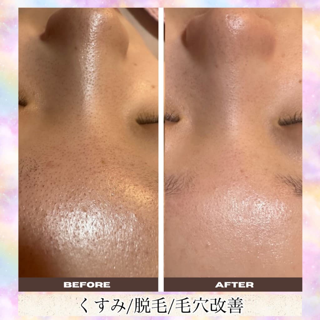 毛穴洗浄のBeforeとAfter(鼻・額・産毛・毛穴)
