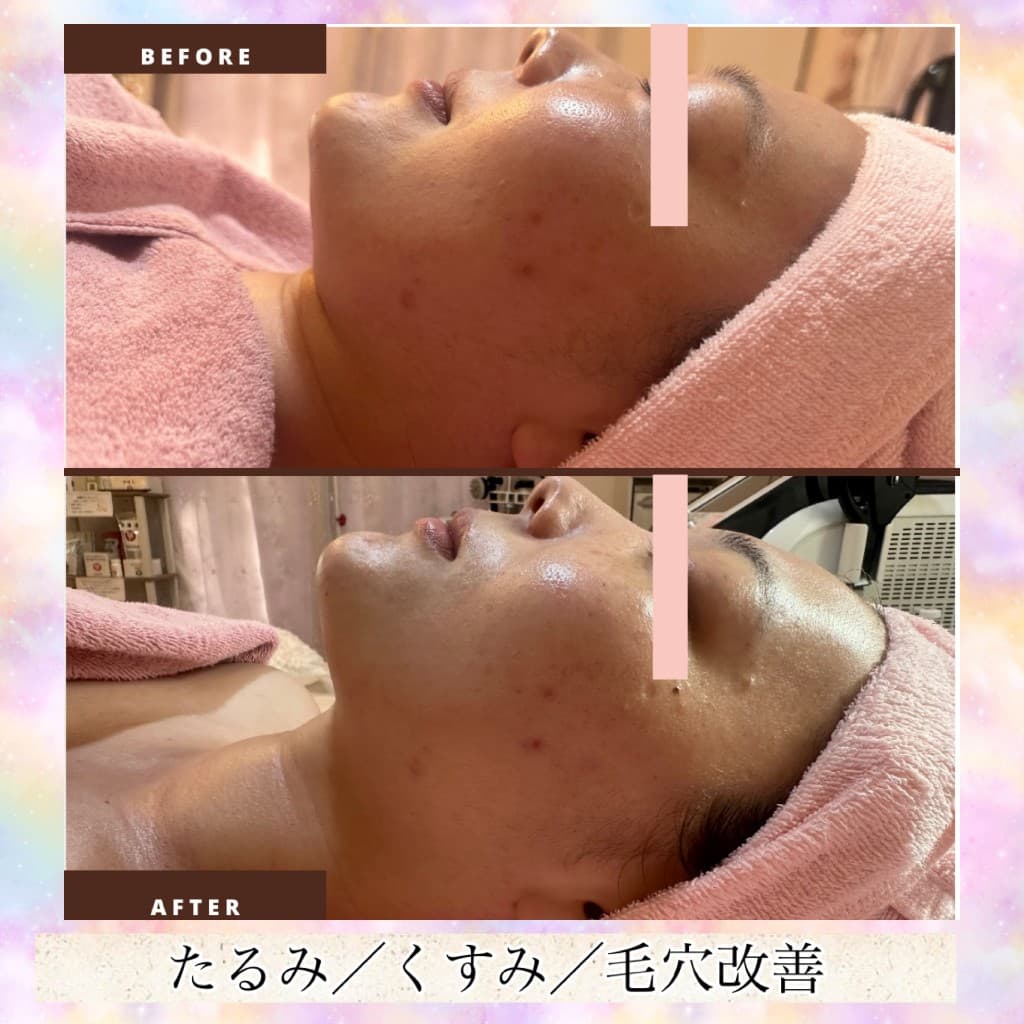 プレミアムコースのBeforeとAfter(横顔・たるみ・くすみ・毛穴)