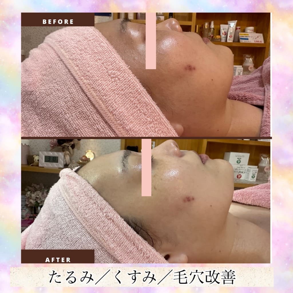 プレミアムコースのBeforeとAfter(横顔・フェイスライン)