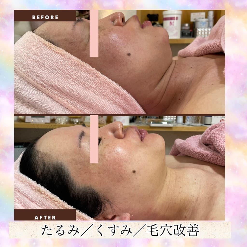 プレミアムコースのBeforeとAfter(横顔・たるみ・くすみ・毛穴)