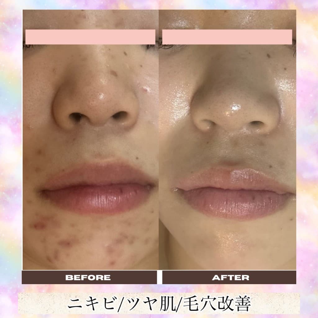 肌質改善のBeforeとAfter(口元・ニキビ・ツヤ肌・毛穴)