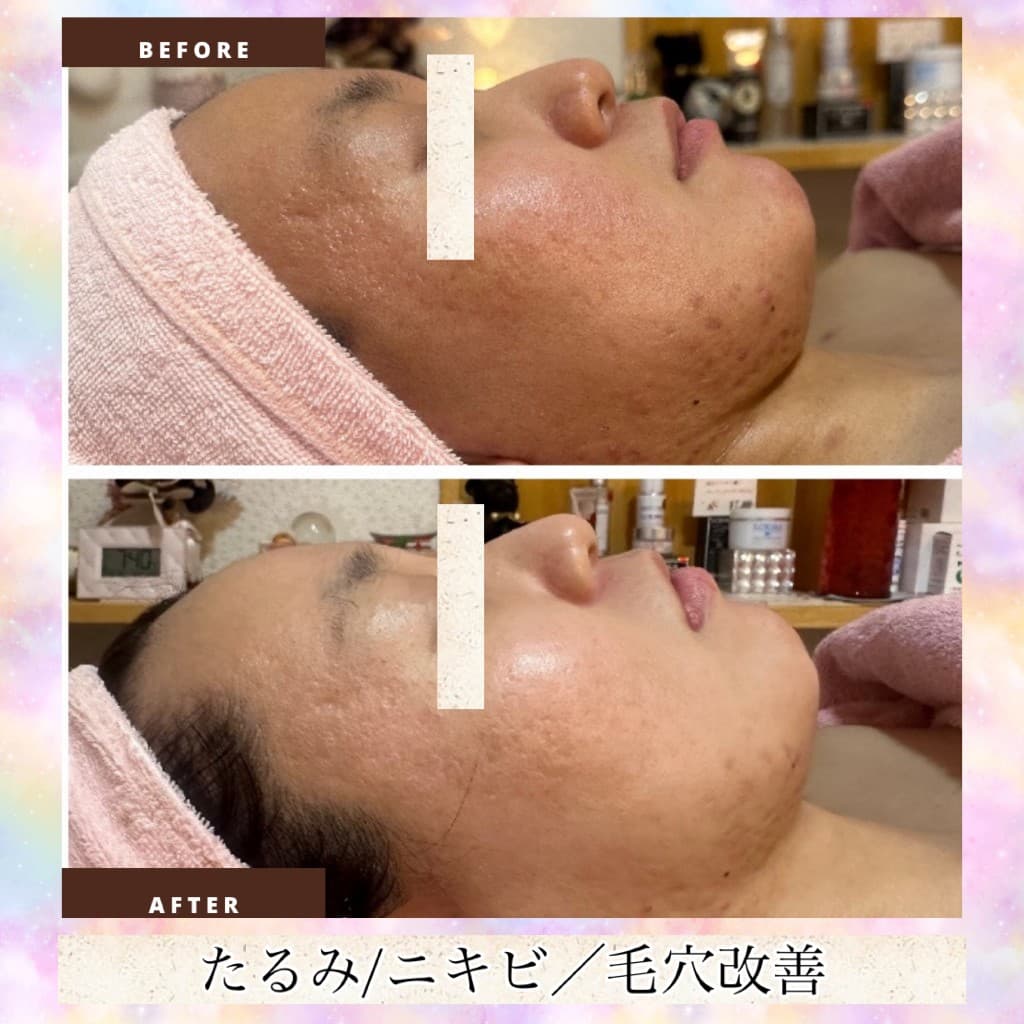 肌質改善のBeforeとAfter(横顔・たるみ・ニキビ・毛穴)